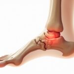 Fersensporn: Ursachen, Symptome & Behandlung