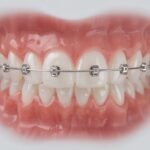 Retention nach Zahnspange: Ergebnis dauerhaft sichern